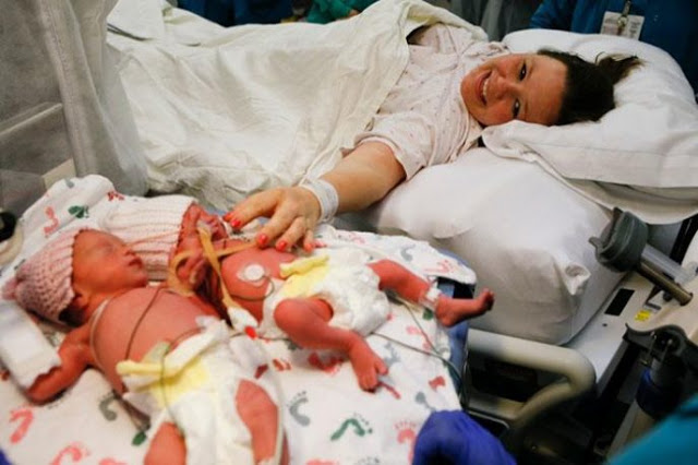 Справжнє чудо і радість для матусі. Лікарі вперше таке бачили… Дівчатка-близнючки народилися, тримаючи одна одну за руки. (ФОТО)