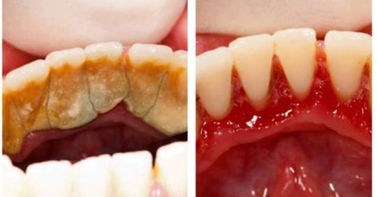 Це неймовірно простий і дешевий спосіб позбутися від зубного каменю, який на відміну від хімічних препаратів не шкодить зубам, а навпаки зміцнює їх!
