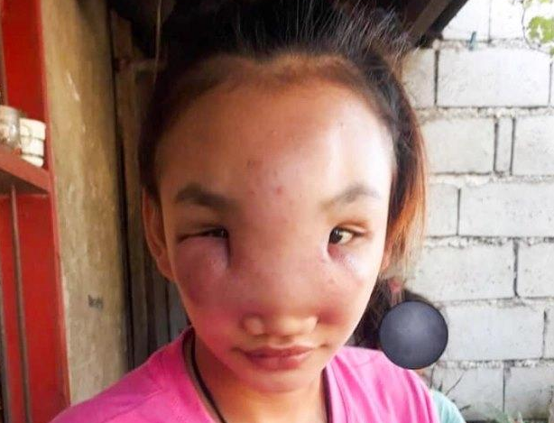 Дівчина почала втрачати зір від таємничої хвороби, після того як вичавила на носі прищ…