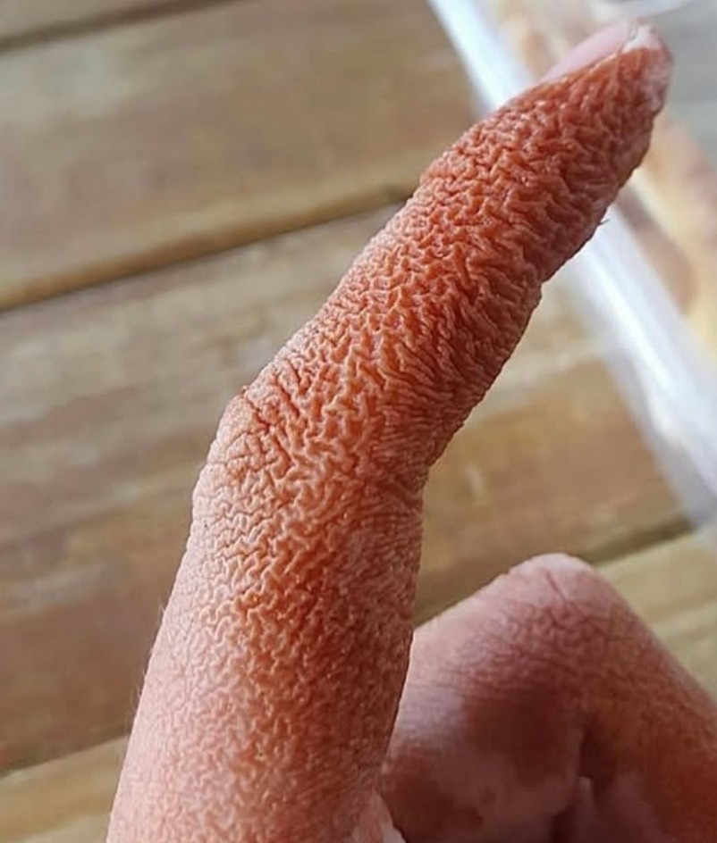 ПОПЕРЕДЖЕННЯ: Рідкісна шкірна реакція, пов’язана зі зміною інгалятора, підвищує медичну обізнаність